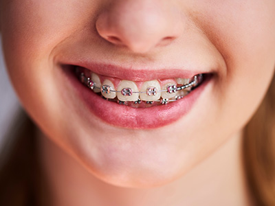 The image shows a young person with braces smiling at the camera.