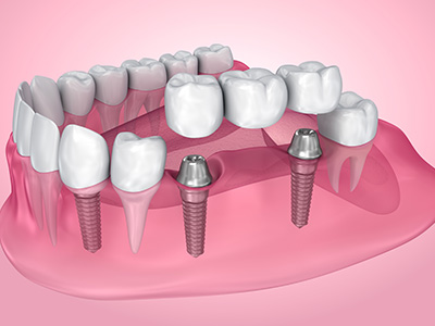 The image displays a 3D rendering of a set of teeth with screws inserted into them, showcasing dental implant technology.