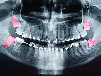 The image shows a close-up view of a human skull with visible teeth and red markers on the jaw area.