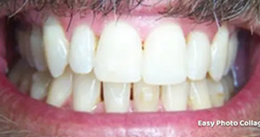 This image features a close-up view of a person s mouth showcasing yellowed teeth and a mustache, against a blurred background.