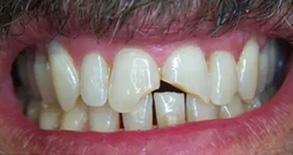 The image shows a person with a large smile revealing multiple missing teeth, including the front teeth, and stained yellowish-brown teeth.