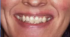 This is a split-screen image showing a person with a wide smile on the right side and an exaggeratedly large, distorted smile on the left side, possibly for comedic effect.