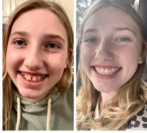 The image shows a person with braces smiling at the camera. There are three photos side by side, each capturing a different angle of the individual s face.