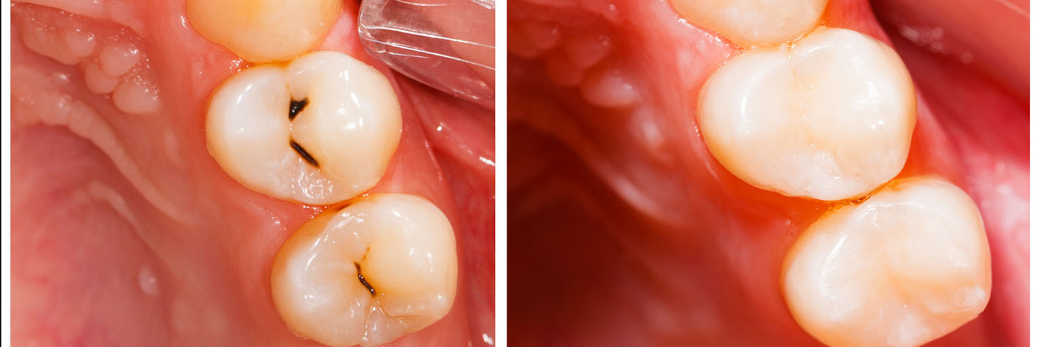 The image shows a close-up view of a human mouth with several teeth, including two with visible cavities, and a tongue with a small puncture mark.