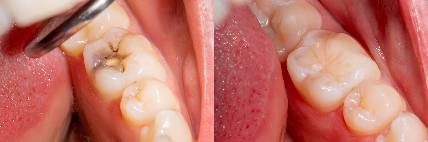 The image shows an open mouth with teeth and gums, displaying a close-up view of dental work being performed.
