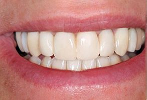 The image shows a person with a wide smile, showcasing white teeth and a bright smile, likely for dental care advertisement purposes.