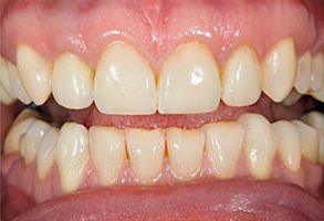 The image shows a close-up of a person s mouth with teeth that are yellowed and stained, indicating poor dental hygiene or health issues.