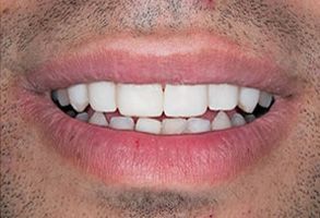 The image shows a close-up of a person s mouth with teeth, featuring a wide smile, against a neutral background.