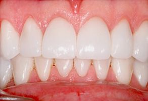The image shows a close-up view of a person s teeth with a focus on a dental implant, highlighting its appearance and condition compared to the surrounding natural teeth.