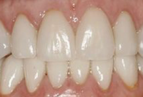 The image shows a close-up view of a person's teeth with a focus on the front teeth, which are white and appear to be well-maintained.
