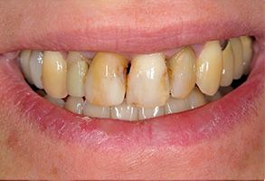 The image shows a person with yellow teeth and gums, smiling at the camera.