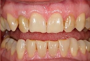The image shows two close-up photographs of a person s teeth with significant discoloration and staining, indicating poor oral hygiene or dental issues requiring attention.