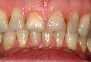 The image shows two views of a person s teeth with yellow stains and discoloration, indicating the need for dental care or whitening treatment.